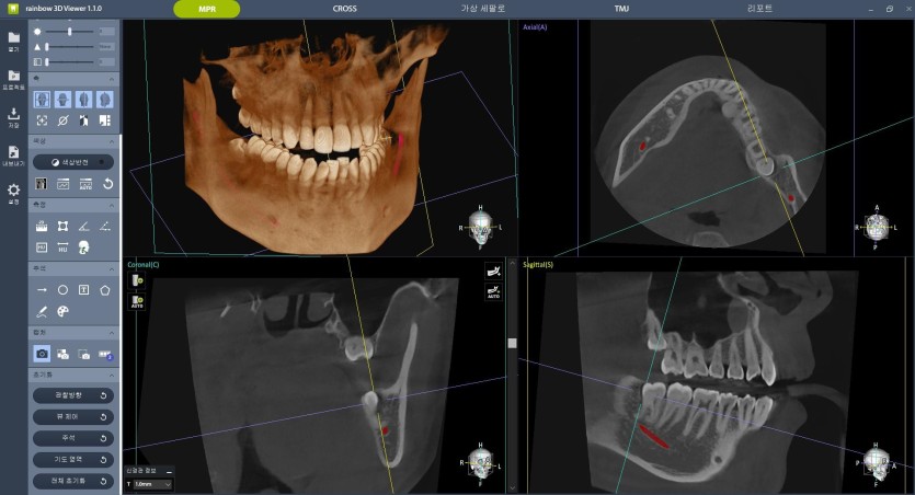 3D-CT — 뒤쪽 뿌리 끝이 하치조신경과 맞닿아 있는 모습