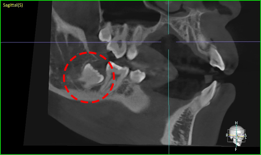 사랑니 CT 검사 - (Sagittal cut, 시상면)