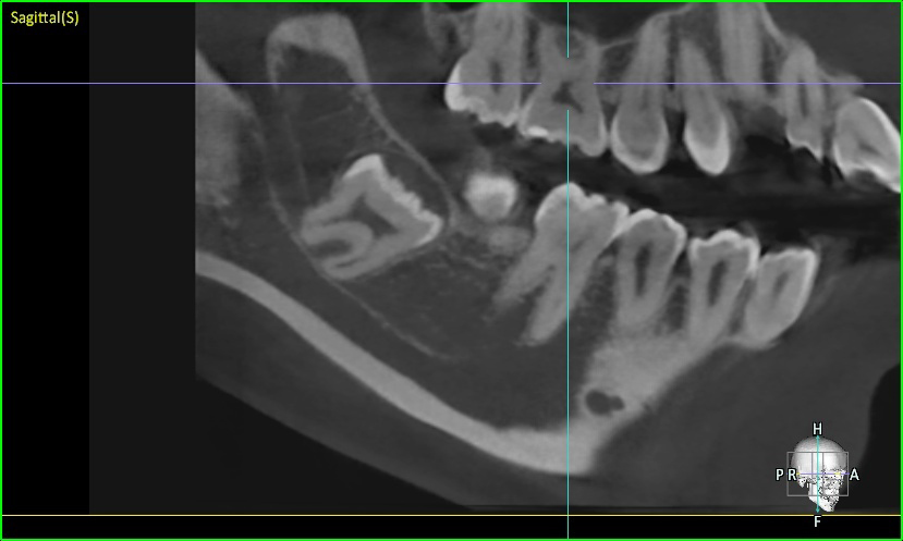CT 검사 (Sagittal cut, 시상면) - 하치조신경관의 상하 전 범위에 걸쳐 사랑니 뿌리가 겹쳐 있는 모습