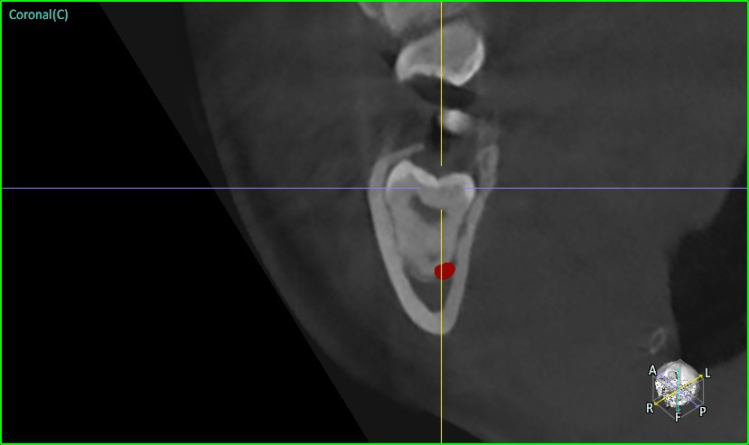 CT 검사 (Coronal cut, 관상면) - 사랑니 뿌리 직하방에 붙어 있는 하치조신경관 (붉은색 표시 부위)