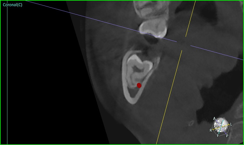 CT 검사 (Coronal cut, 관상면 후방) - 후방으로 갈수록 사랑니에 더 가깝게 붙어 있는 하치조신경