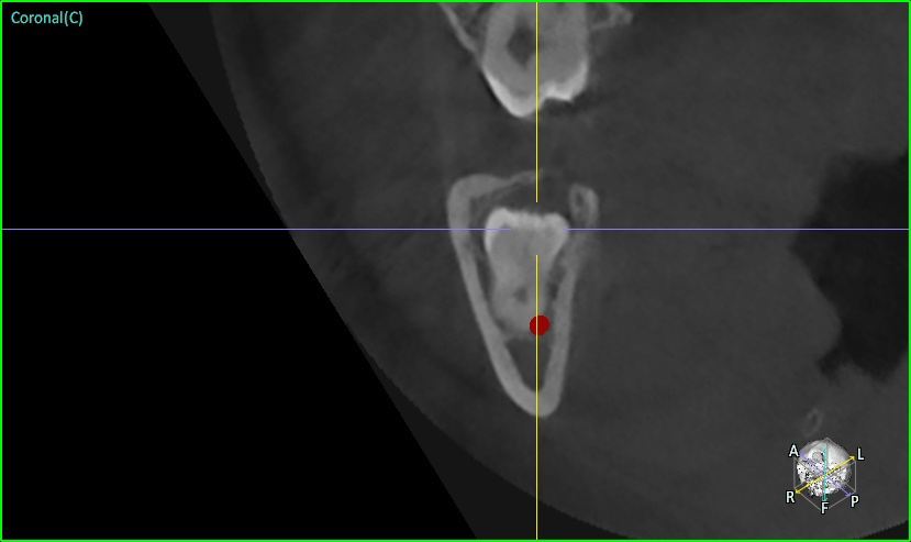 CT 검사 (Coronal cut, 관상면 후방) - 후방으로 갈수록 사랑니에 더 가깝게 붙어 있는 하치조신경